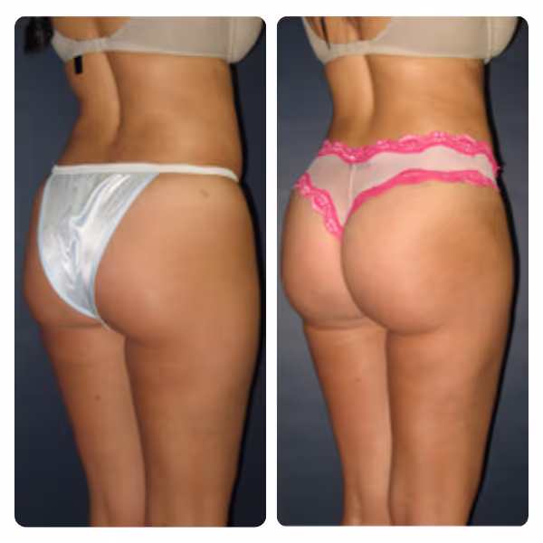 Brazilian Butt Lift (BBL) in Turkey